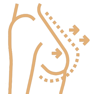 Gynecomastia 