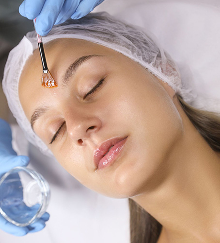 Chemical Peels