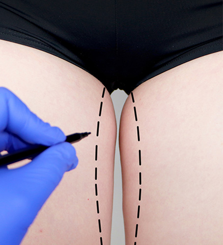 Flap Surgery