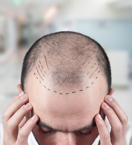 Hair Transplant - FUE & FUT