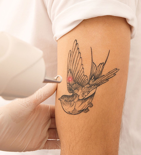 Tatto Removal