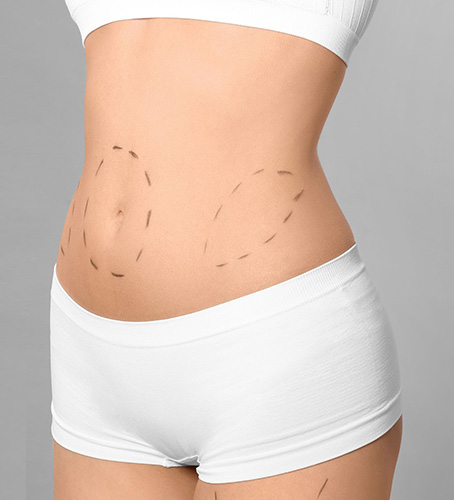 Tummy Tuck