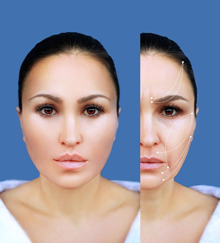 Face Lift, Thread Lift