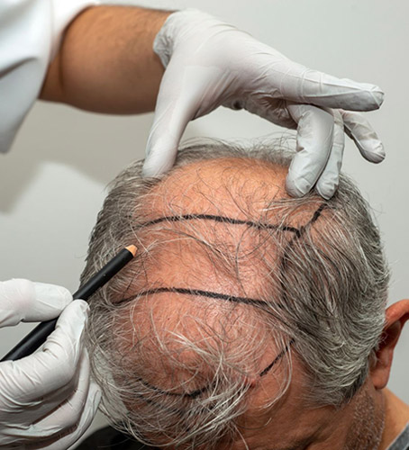 hair transplant treatment