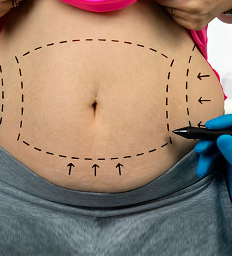 Liposuction procedure