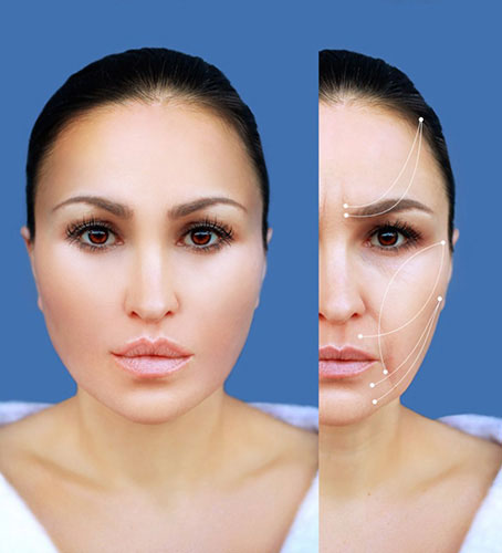 Face Lift, Thread Lift