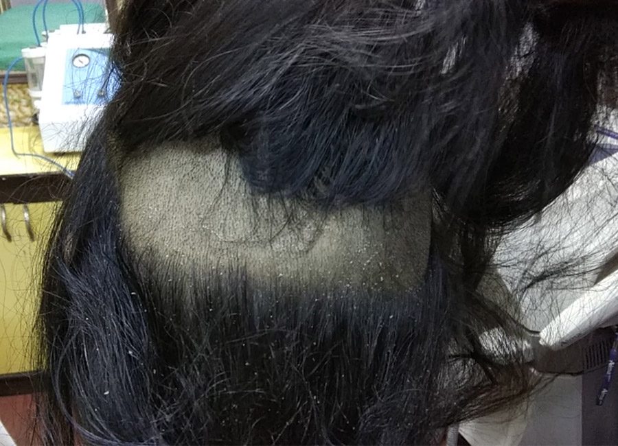 Hair Loss Treatment
