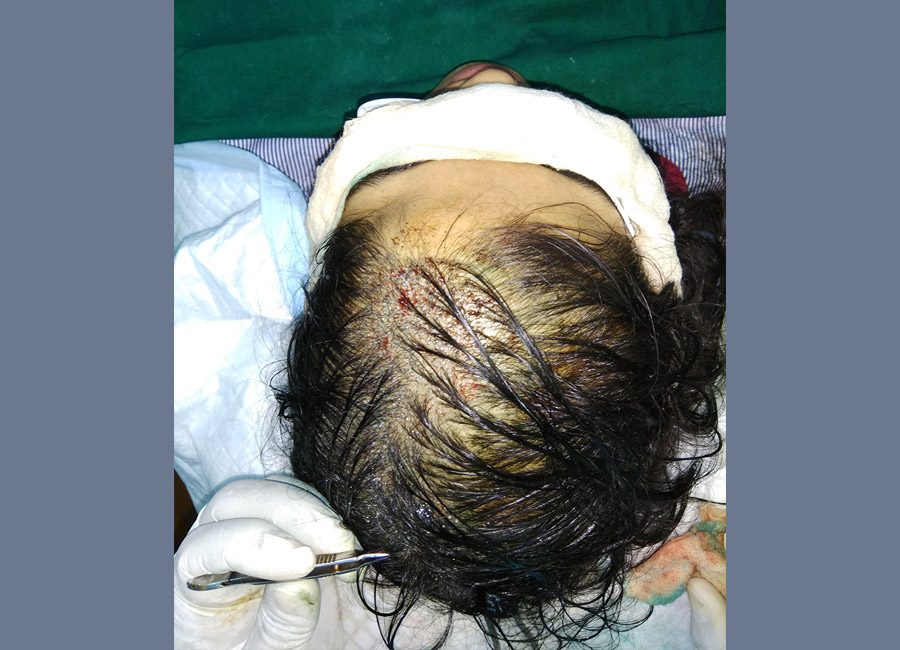 Hair Loss Treatment