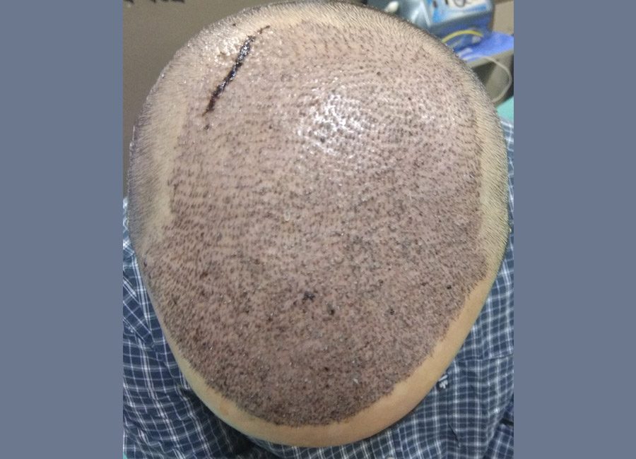 Hair Transplant