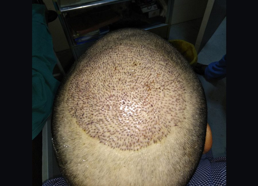Hair Transplant