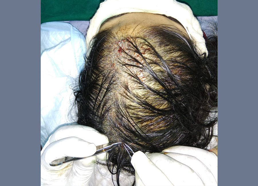 Hair Loss Treatment