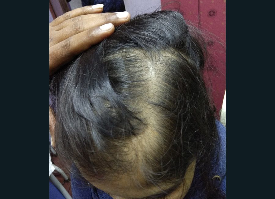Hair Loss Treatment