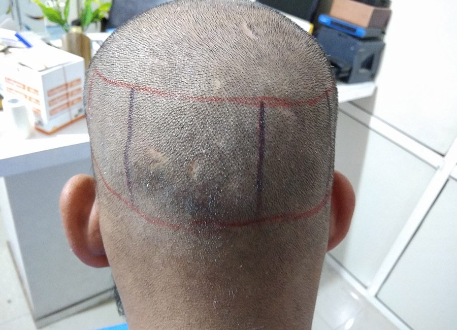 Hair Transplant