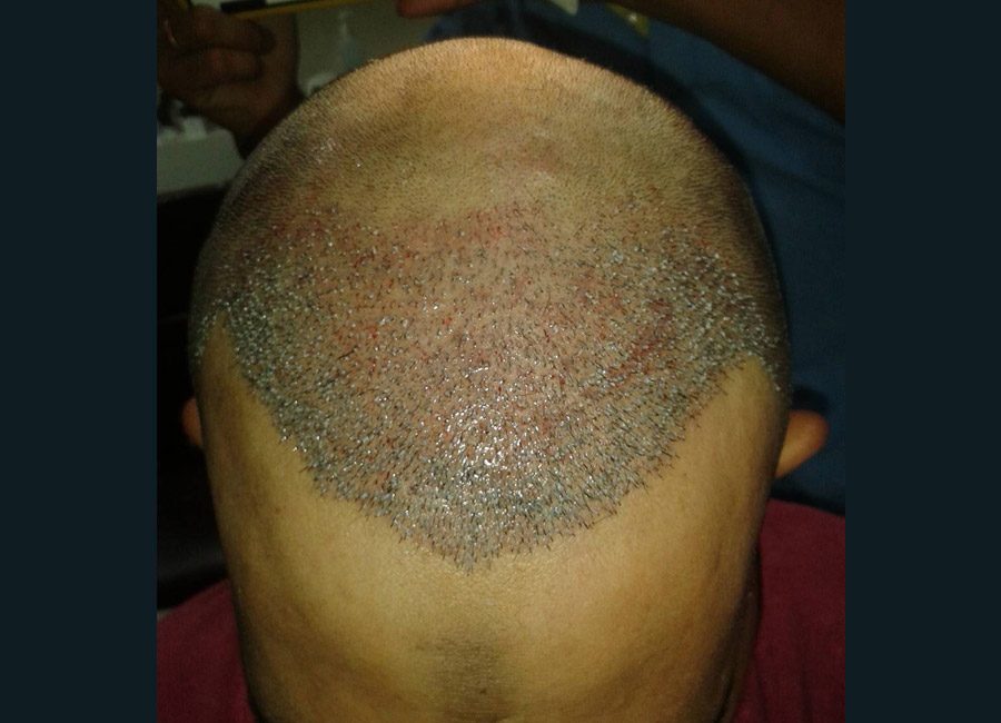 Hair Transplant