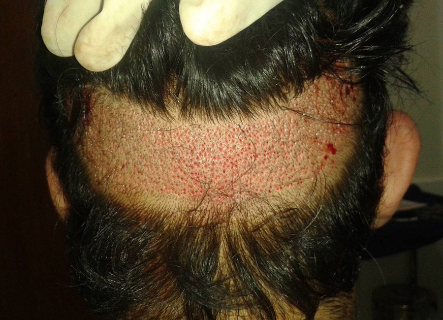 Hair Loss Treatment