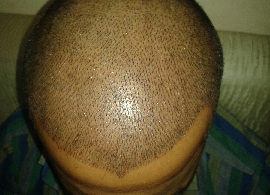 Hair Transplant
