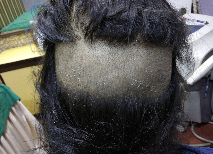 Hair Loss Treatment